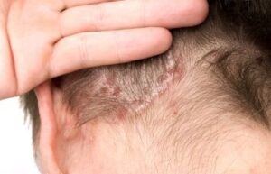 What Makes Your Scalp Itchy