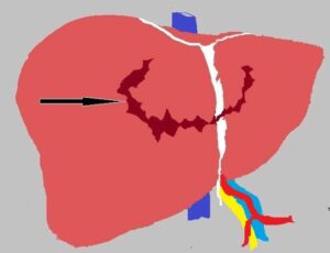 liver injuries